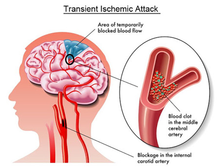 the-neurology-practice-transient-ischemic-attack